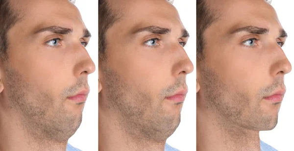 Double Chin Problem Collage Photos Man Plastic Surgery Procedure White — Stock Photo, Image