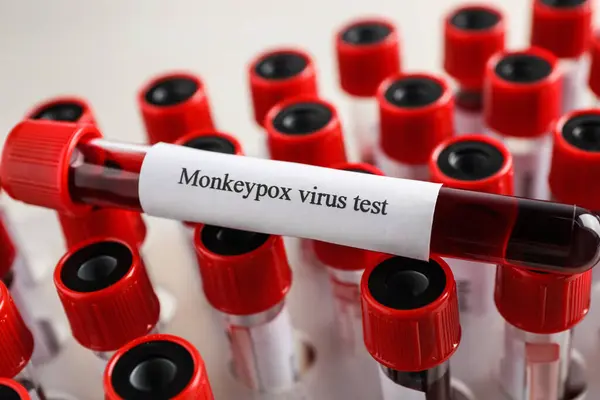 stock image Monkeypox virus test. One sample tube with blood on others, closeup