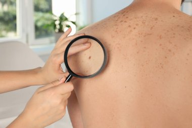 Dermatolog, klinikte büyüteçle hastanın doğum lekesini inceliyor.