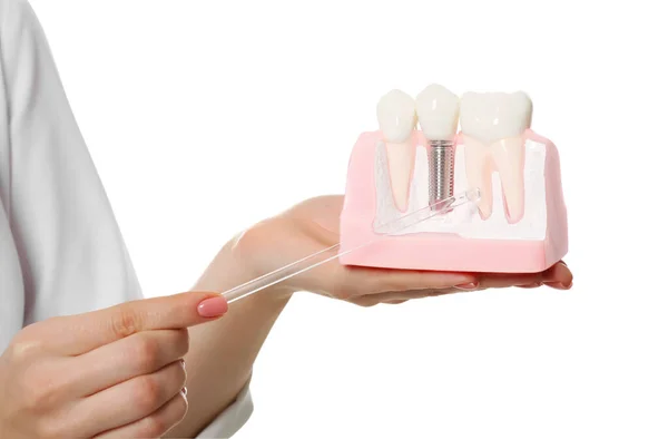 Tandarts Het Bezit Educatief Model Van Tandheelkundig Implantaat Witte Achtergrond — Stockfoto