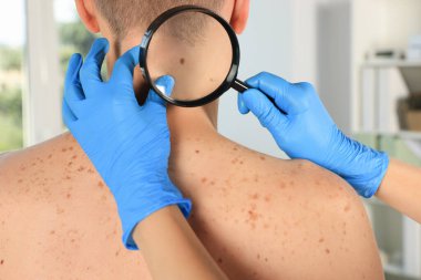Dermatolog, klinikte büyüteçle hastanın doğum lekesini inceliyor.