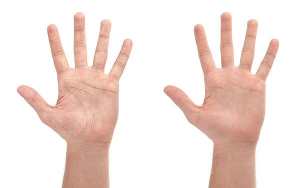 Коллаж Фотографиями Человека Показывающего Руки Сухой Увлажненной Кожей Белом Фоне — стоковое фото