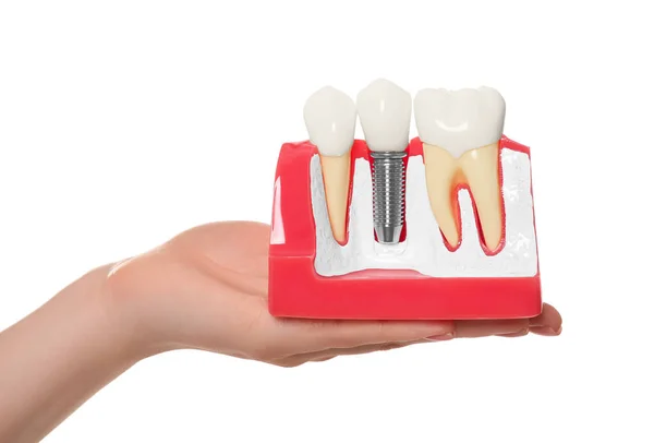 Стоматолог Тримає Навчальну Модель Імплантації Зубів Білому Тлі Крупним Планом — стокове фото