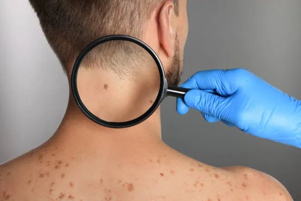 stock image Dermatologist examining patient's birthmark with magnifying glass on grey background, closeup