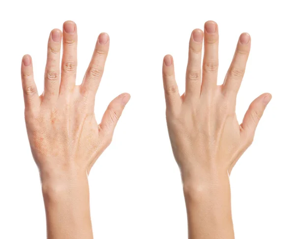 Коллаж Фотографиями Женщины Показывающей Руки Сухой Увлажненной Кожей Белом Фоне — стоковое фото