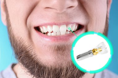 Diş implantı taktıktan sonra gülümseyen adam mavi arka planda, yakın plan.