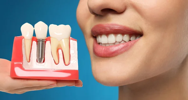 Ung Kvinna Med Vackert Leende Och Tandläkare Innehar Utbildningsmodell Tandimplantat — Stockfoto