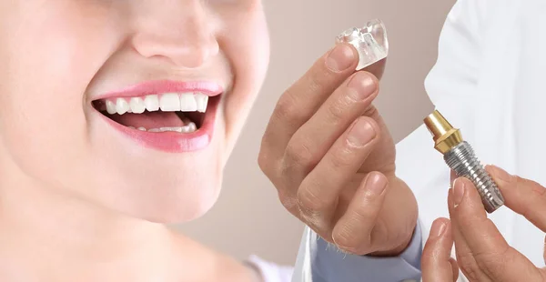 Mujer Joven Con Hermosa Sonrisa Dentista Sosteniendo Modelo Educativo Implante —  Fotos de Stock