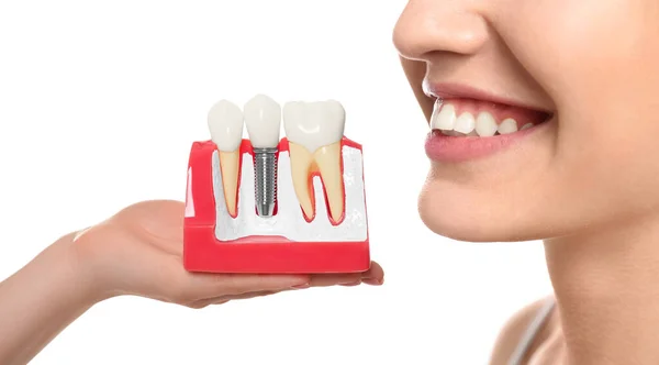 Молода Жінка Красивою Посмішкою Стоматолог Тримає Освітню Модель Імплантації Зубів — стокове фото