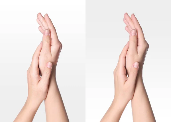Colagem Com Fotos Mulher Mostrando Mãos Com Pele Seca Hidratada — Fotografia de Stock
