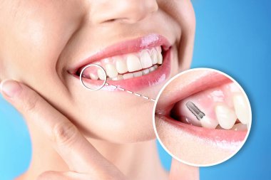 Mavi arka planda diş implantı yerleştirme prosedüründen sonra gülümseyen güzel bir kadın.