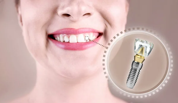 Žena Krásným Úsměvem Instalaci Zubního Implantátu Béžovém Pozadí Detailní Záběr — Stock fotografie
