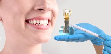 Güzel gülüşü ve dişçisi olan genç bir kadın arka planda diş implantının eğitici modelini tutuyor. Yakın plan. Pankart tasarımı
