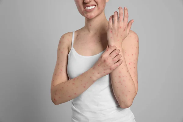 Woman Rash Suffering Monkeypox Virus Light Grey Background Closeup — Stock Photo, Image