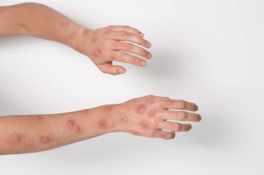 Woman with rash suffering from monkeypox virus on white background, closeup clipart