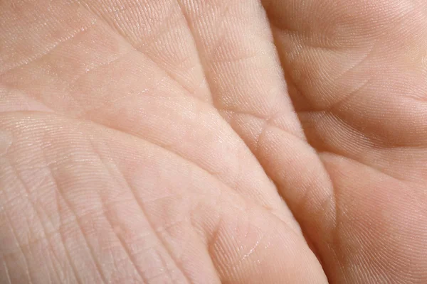 Närbild Mänsklig Hand Med Torr Hud — Stockfoto