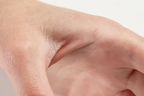 Menino Com Pele Seca Mão Close — Fotografia de Stock