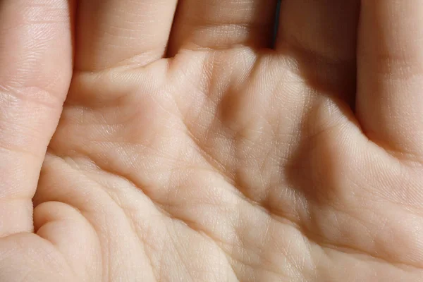 Nahaufnahme Der Menschlichen Hand Mit Trockener Haut — Stockfoto