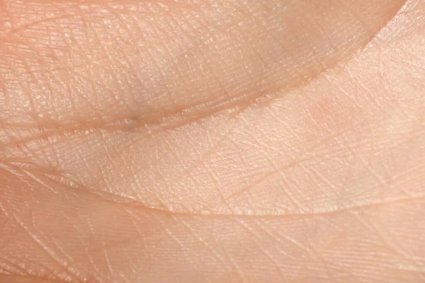 Nahaufnahme Der Menschlichen Hand Mit Trockener Haut — Stockfoto