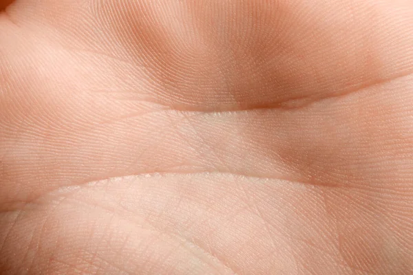Vista Perto Mão Humana Com Pele Seca — Fotografia de Stock