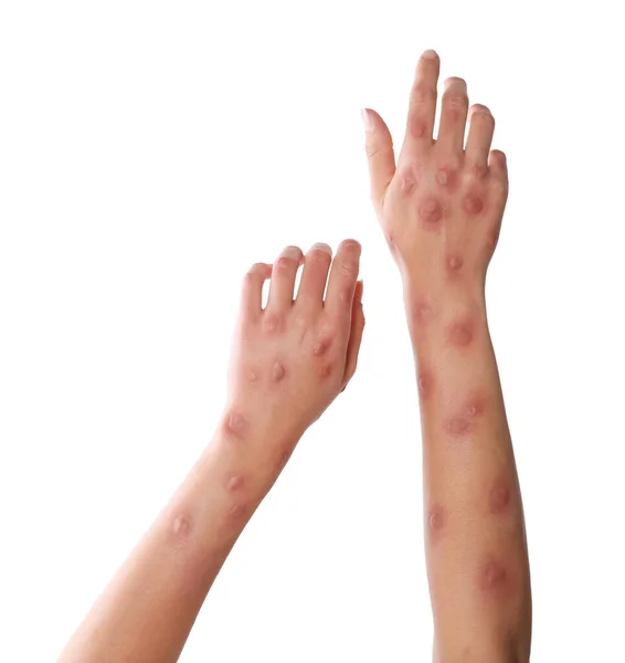 Frau Mit Hautausschlag Leidet Unter Monkeypox Virus Auf Weißem Hintergrund — Stockfoto
