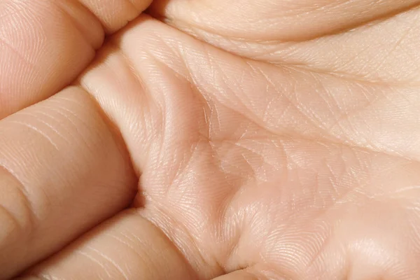 Closeup Άποψη Του Ανθρώπινου Χεριού Ξηρό Δέρμα — Φωτογραφία Αρχείου