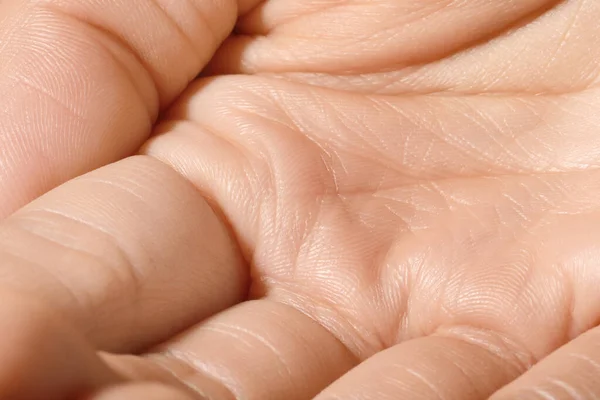 Vista Perto Mão Humana Com Pele Seca — Fotografia de Stock