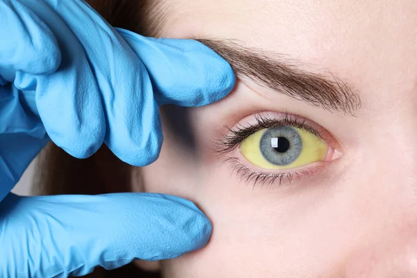 医者は黄色い目の女性をチェックし 閉じます 肝炎の症状 — ストック写真