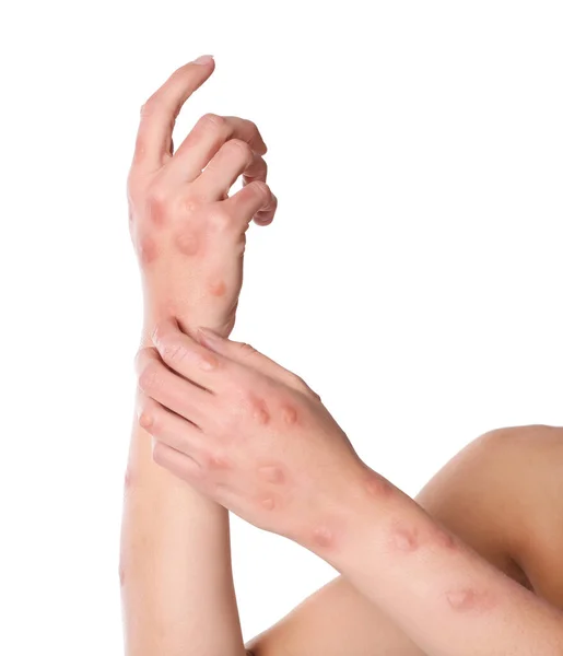 Frau Mit Hautausschlag Leidet Unter Monkeypox Virus Auf Weißem Hintergrund — Stockfoto