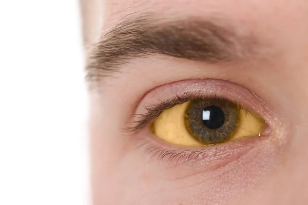 Mann Mit Gelben Augen Auf Weißem Hintergrund Nahaufnahme Symptom Einer — Stockfoto