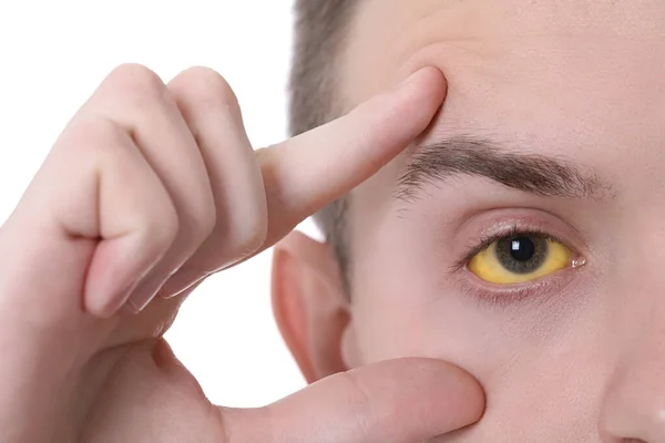 Mężczyzna Sprawdza Stan Zdrowia Białym Tle Zbliżenie Żółte Oczy Jako — Zdjęcie stockowe