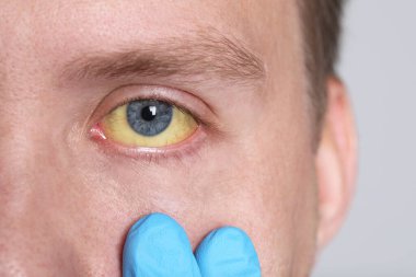 Doktor arka planda sarı gözlü adamı kontrol ediyor, yakın plan. Hepatit belirtileri