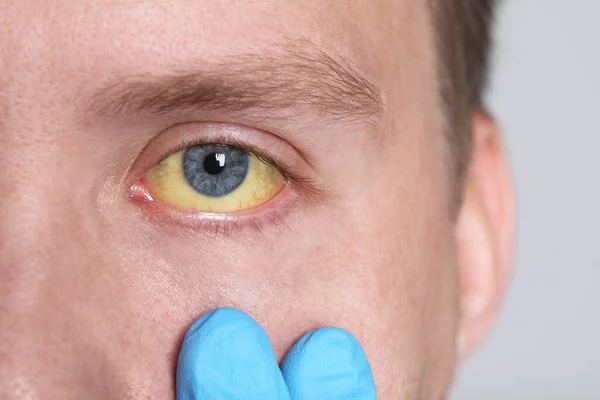 Doutor Verificando Homem Com Olhos Amarelos Fundo Claro Close Sintoma — Fotografia de Stock