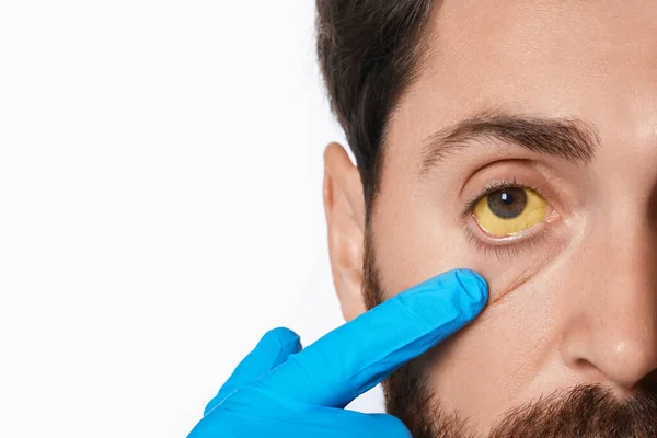 Arzt Kontrolliert Mann Mit Gelben Augen Auf Weißem Hintergrund Nahaufnahme — Stockfoto