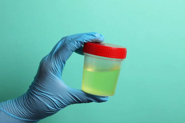 Docteur Contenant Avec Échantillon Urine Pour Analyse Sur Fond Turquoise — Photo