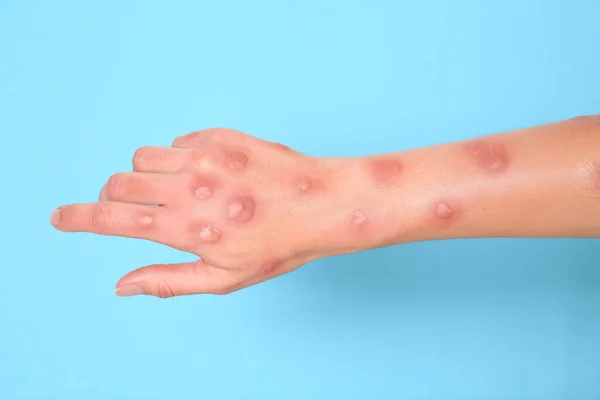 Γυναίκα Εξάνθημα Που Πάσχουν Από Ευλογιάς Monkeypox Γαλάζιο Φόντο Closeup — Φωτογραφία Αρχείου