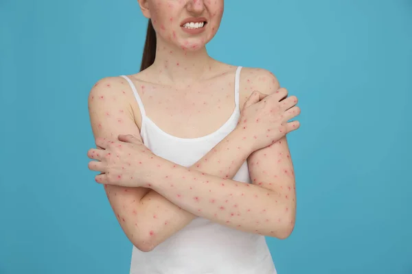 Woman Rash Suffering Monkeypox Virus Light Blue Background Closeup — Stock Photo, Image