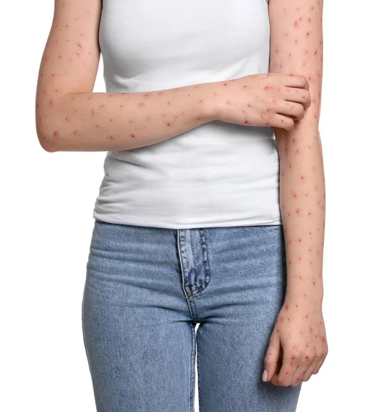 Kobieta Wysypką Cierpiąca Wirusa Ospy Małpiej Białym Tle Zbliżenie — Zdjęcie stockowe