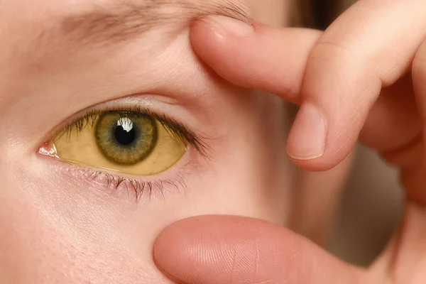 Woman with yellow eyes, closeup. Symptom of hepatitis