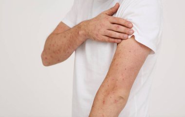 Bej arka planda maymun çiçeği virüsünden muzdarip olan adam, yakın plan.