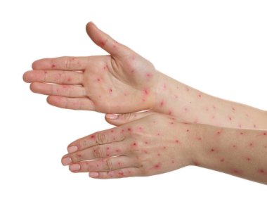 Beyaz arka planda kızarıklık hastalığı olan kadın, yakın plan.