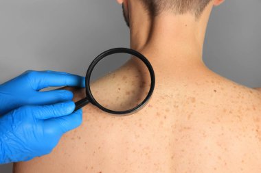 Dermatolog, gri arka planda büyüteçle hastanın doğum lekesini inceliyor.