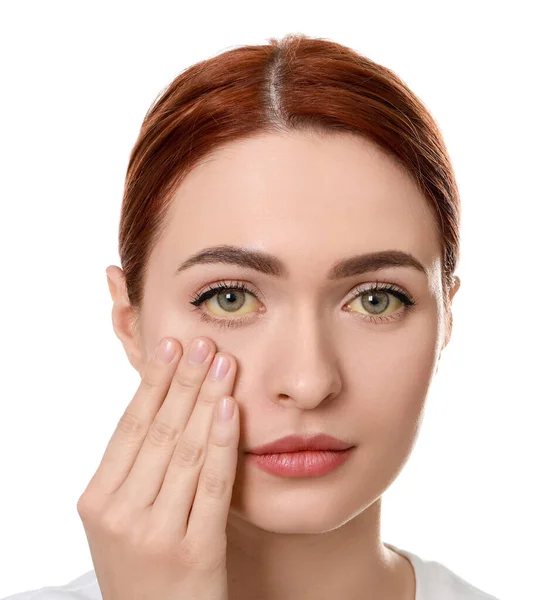 白い背景に黄色い目の女性 肝炎の症状 — ストック写真