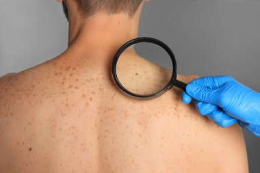 Dermatolog, gri arka planda büyüteçle hastanın doğum lekesini inceliyor.