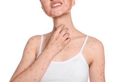 Beyaz arka planda kızarıklık hastalığı olan kadın, yakın plan.