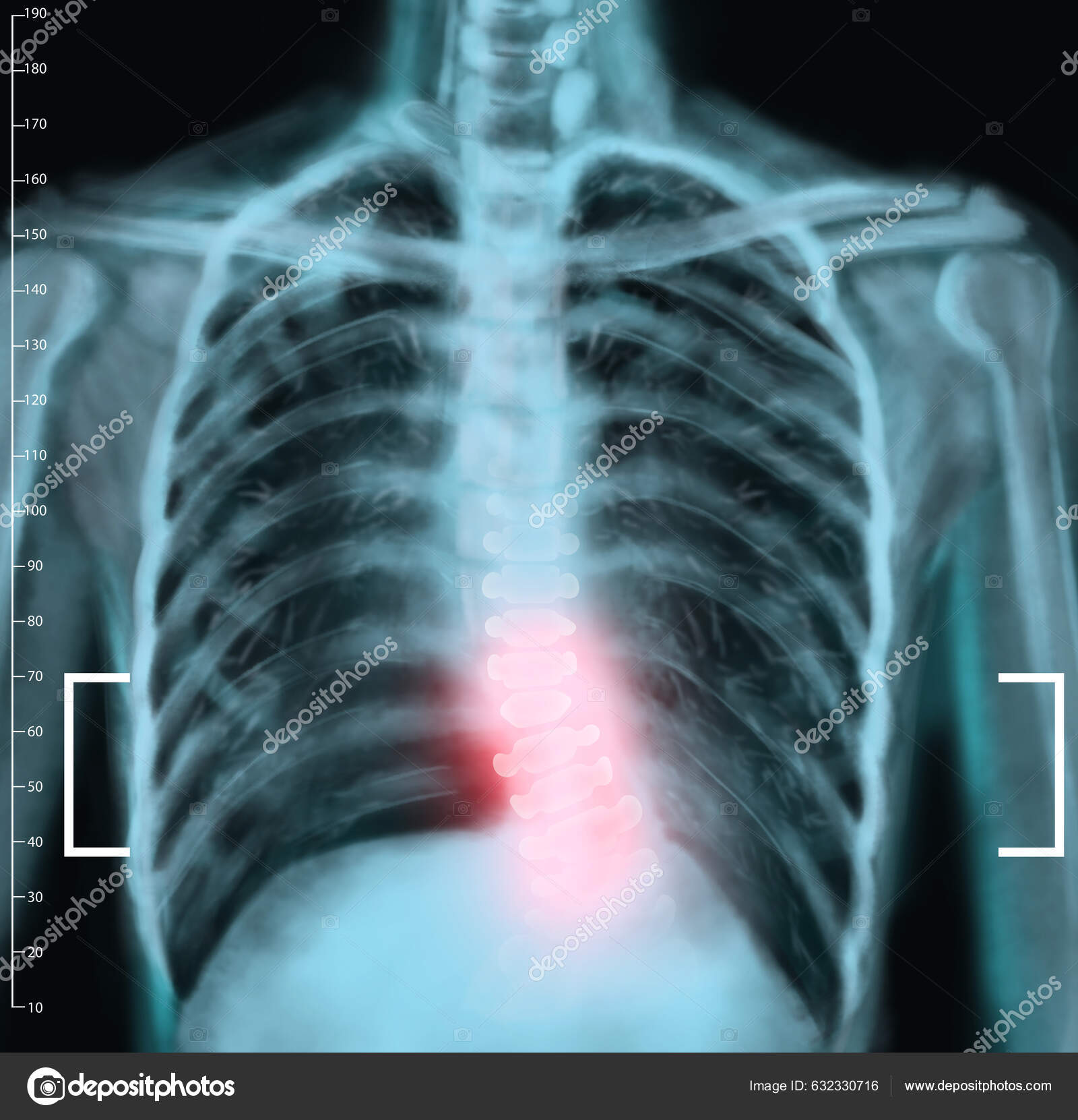 Broken Back X Ray Human
