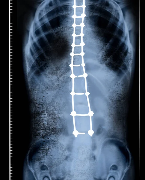 X-ray of human spine showing curvature. Patient suffering from scoliosis