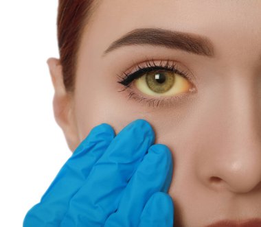 Doctor checking woman with yellow eyes on white background, closeup. Symptom of hepatitis clipart