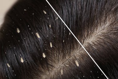 Collage showing woman's hair before and after lice treatment, closeup. Suffering from pediculosis