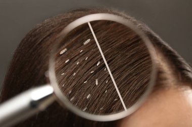 Collage showing woman's hair before and after lice treatment on grey background, closeup. View on parasitic insect through magnifying glass. Suffering from pediculosis